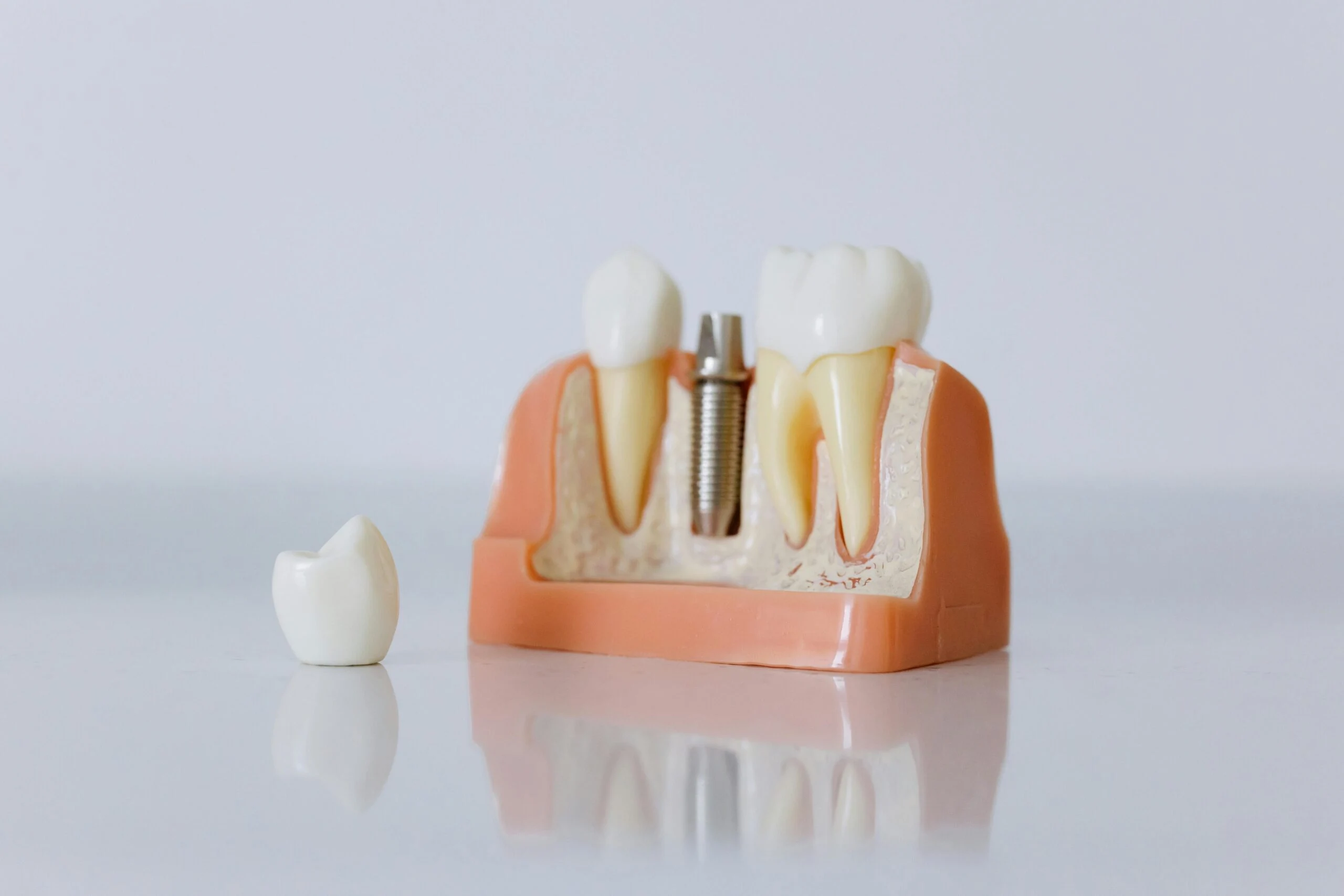 Dental Implants, supporting dental care photograph